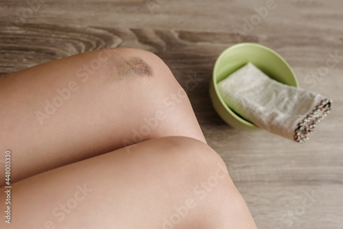 Physical injury of female knee with contusion and bruise, closeup photo photo