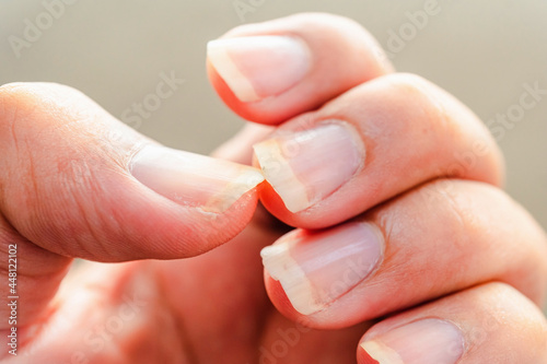 Long nails must always be maintained and beautiful. Very dirty nails. which require urgent treatment. Dirty nails can cause serious contagious diseases  incomplete manicure for the background.