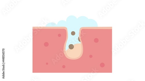 Cleaning clogged pores process 2D animation on white background. Blackheads removal, skin cleaning foam, skincare. For topics like cosmetology, cosmetics. Shrinking and minimaizing pores