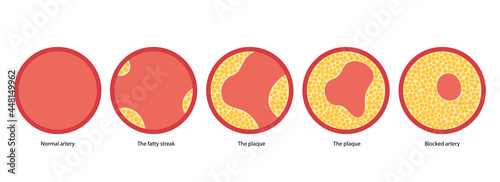 Cholesterol and atherosclerosis