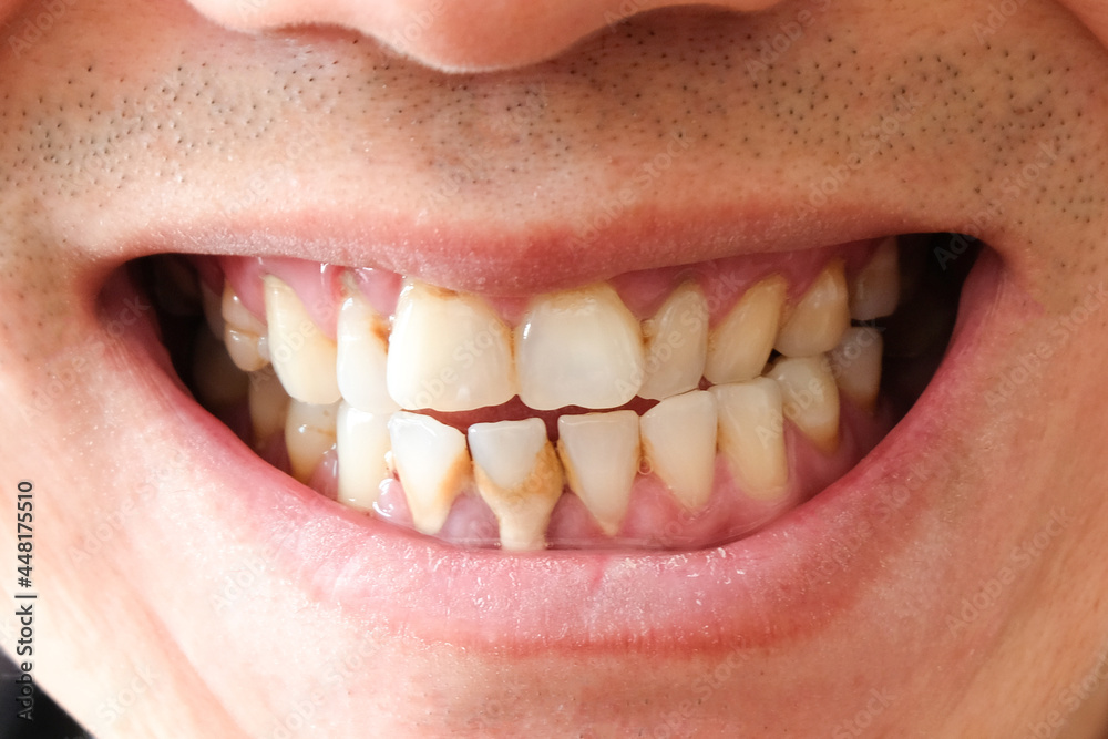 Fototapeta premium Tooth's a man smoking bad. Man smokes a cigarettes have tooth decay and calculus on teeth, So we should be care dental with the hygiene