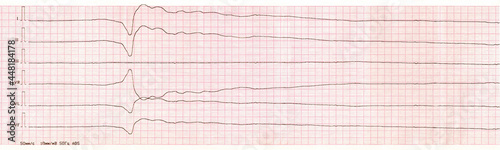 ECG tape with single idioventricular complex and ventricular asystole
