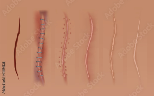 Set of healing wounds, skin scars, stitched gash and cuts. Realistic surgical sutures, stitched wounds at different healing stages isolated on human skin background