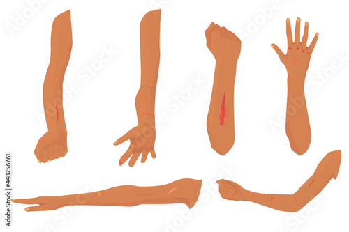 set of wounds and abrasions on hands isolated on white background. ripped knuckles, cuts, stitches on the wound, scars, scratches. injury. treatment of wounds. vector flat. hospital
