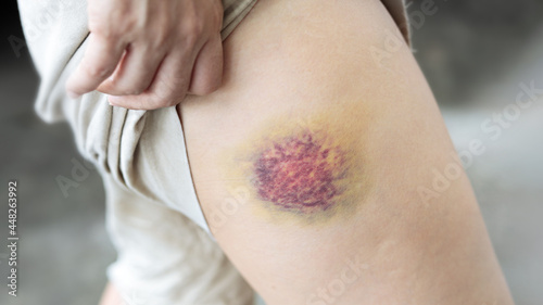 A woman shows a bruise on her leg.