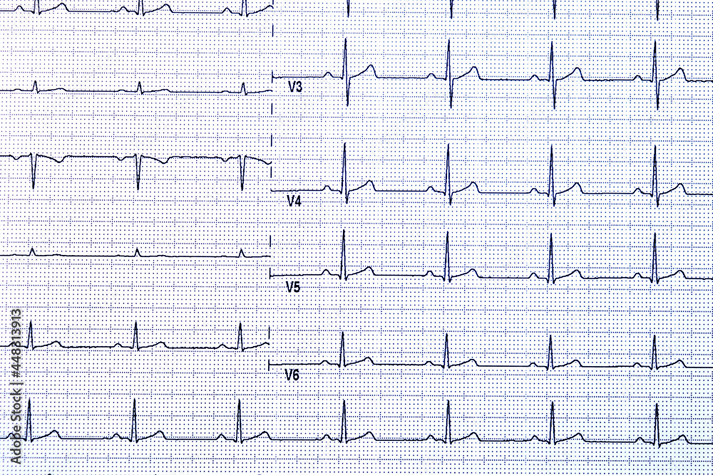 ekg heart beat