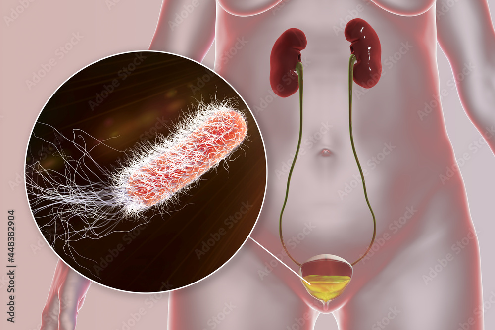Cystitis, bacterial infection of urinary bladder, conceptual 3D ...