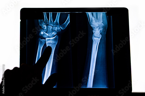 Doctor checking radiography examining x-ray film of patient's arm pointing to radius fracture. X-rayed human hand. X-ray of hand bones. Medical technology radiography. photo