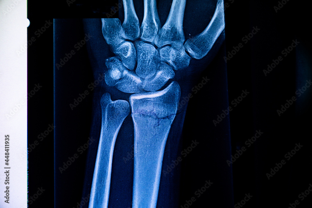 Radiography examination of radius fracture. Xray human arm. Xray of