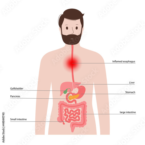 esophageal cancer concept