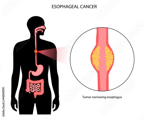 esophageal cancer concept photo