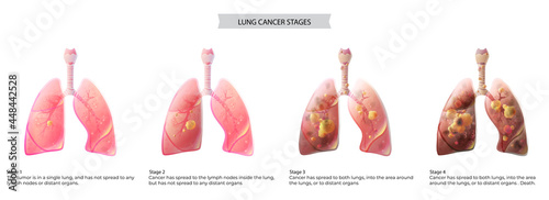 Fotografie Lungs cancer disease