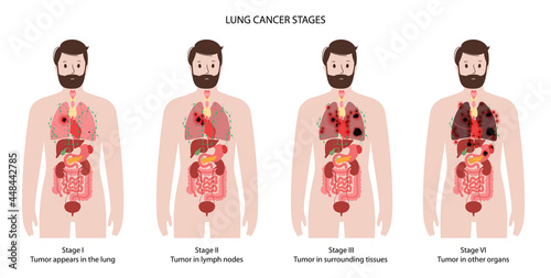 Lungs cancer stages