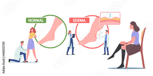 Edema, Lymphedema Disease. Tiny Doctor and Patient Characters at Huge Infographics Presenting Healthy and Diseased Legs photo
