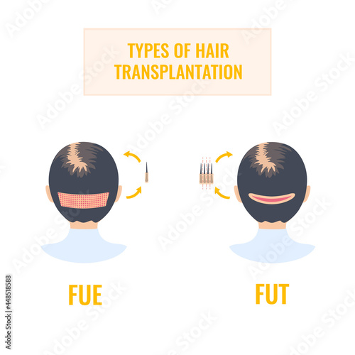 Hair transplantation infographics of woman head in rear view. FUT and FUE female alopecia treatment methods. Follicular unit extraction vs follicular unit transplantation. Medical vector illustration
