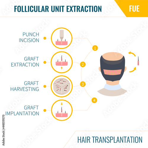 FUE hair transplantation infographics. Male alopecia treatment method. Follicular unit extraction surgery steps. Man with balding head in rear view. Medical vector illustration.