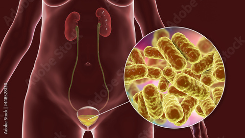 Cystitis, bacterial infection of urinary bladder, conceptual 3D illustration photo