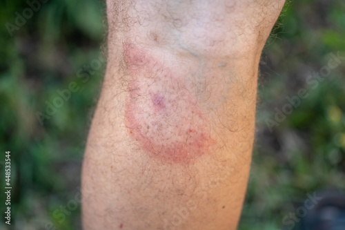 migrating erythema after a tick bite on a man\'s leg. a symptom of tick-borne borreliosis. a red ring in the form of a target on the leg