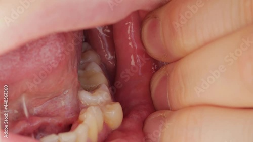 Deep caries in the patient's jaw tooth and displacement of the crooked tooth. Dental treatment concept in dentistry, macro photo