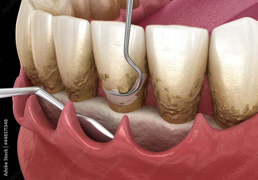Open curettage Scaling and root planing (conventional periodontal