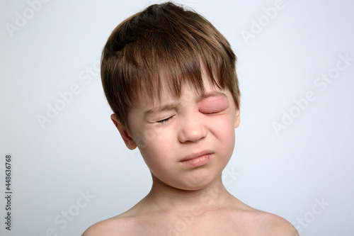 Canvas Print A boy with swollen eye from insect bite