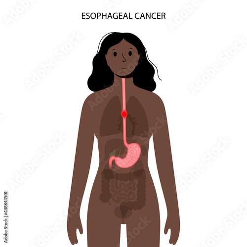 esophageal cancer concept