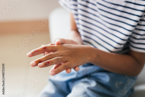 Fresh wound and blood from injured on child fingers after she has been an accident.