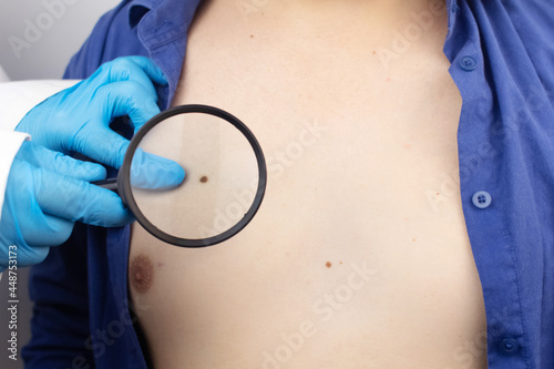 A man at a dermatologist appointment shows his birthmarks, moles and nevi. The doctor examines the patient with a dermatoscope. Benign and malignant birthmarks. Skin abnormalities care concept