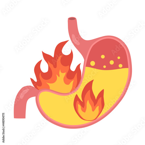 Human stomach on fire in flat design on white background. Heartburn concept. Acid reflux disease.