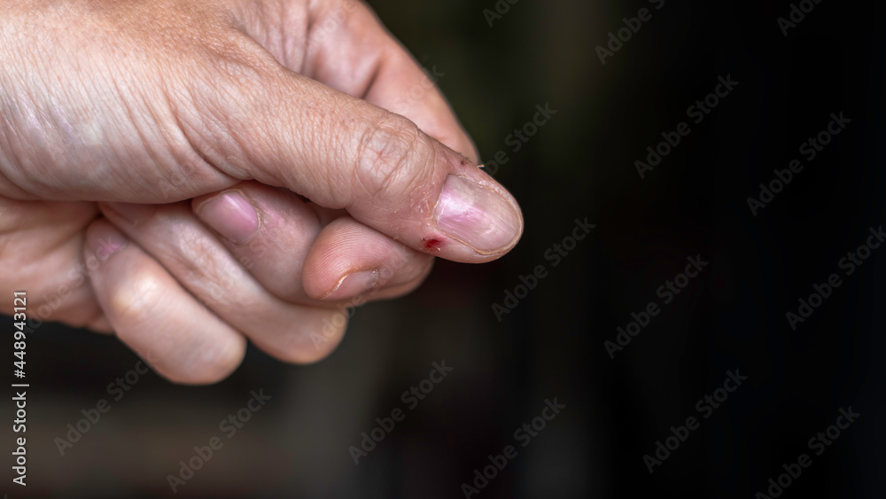 Male hand with thumb injury. Fingernail pain. Bad habits, biting and ripping off hangnails on fingernails. Selective focus. With copy space Male hand with thumb injury. Fingernail pain. Bad habits, biting and ripping off hangnails on fingernails. Selective focus. With copy space