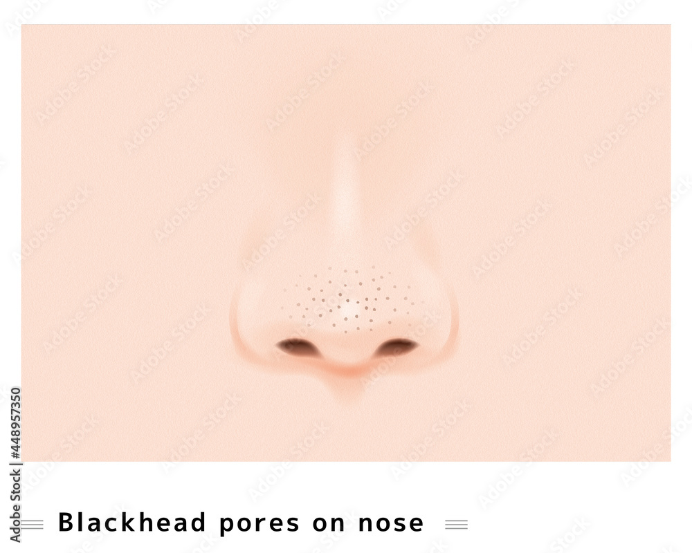 鼻 黒ずみ 鼻の穴 毛穴 ケア 美容 治療 スキンケア いちご鼻 角栓 ポツポツ 目立つ イラスト ベクター Stock Vector Adobe Stock