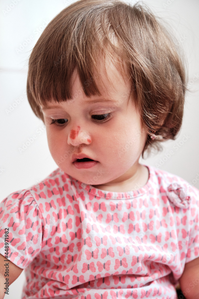 Close up portrait baby girl with a scratch on her nose isolated on the white background. Child safety concept, injuries from falling down Close up portrait baby girl with a scratch on her nose isolated on the white background. Child safety concept, injuries from falling down
