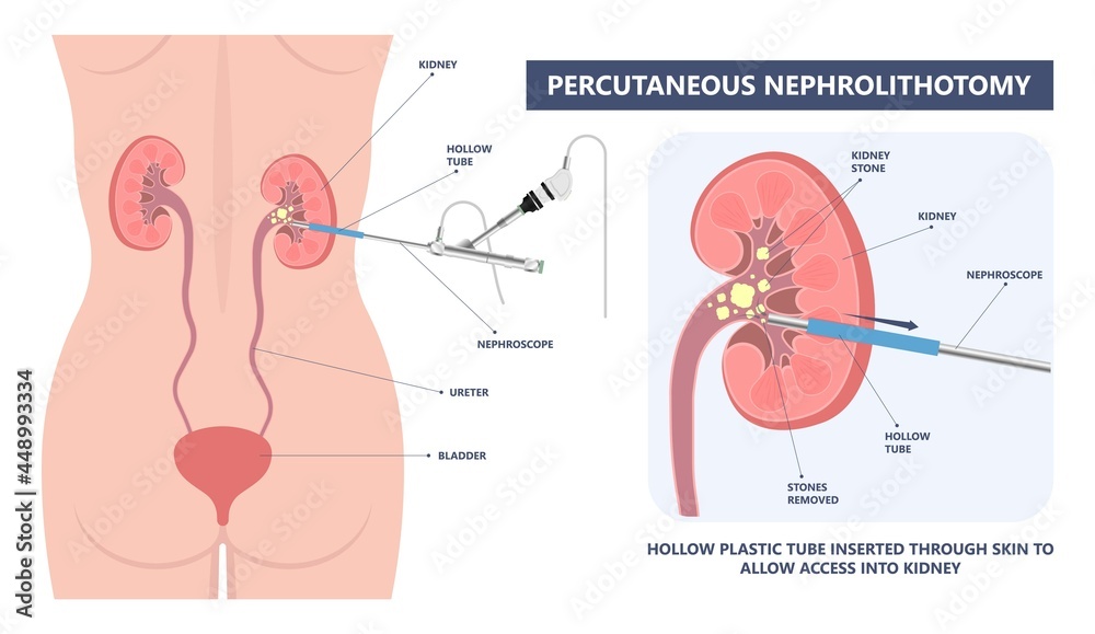 Tube Stent bag blocked kidney stone tumor urine urinary Drain renal