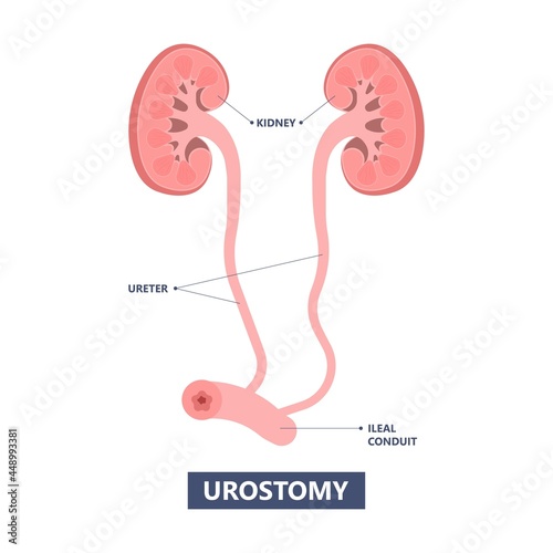 Tube Stent bag blocked kidney stone tumor urine urinary Drain renal ileal conduit stoma foley bladder pelvis Obstructive ureter shock wave ESWL pain cystitis remove surgery pee Cancer tract transplant