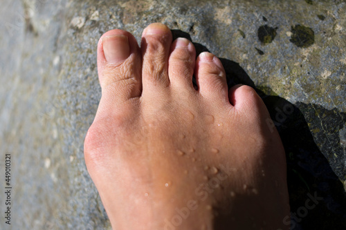 Bunions hallux valgus photo