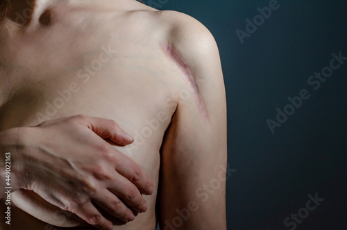 фотографія Colloidal scar on woman shoulder after surgery, installation of metal plate on bone