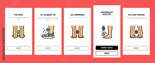 Flat Feet Disease Onboarding Mobile App Page Screen Vector. Orthopedic Insoles And Shoes, Inward And Outward Curvature Of Legs, Flat Feet Treatment Illustrations