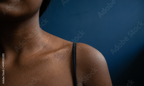 Close-up shot of a girls shoulder and clavicle on a isolated blue background affected with dermatitis | concept of medical and healthcare