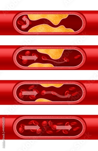 Atherosclerosis artery. Step-by-step cholesterol deposition arterial walls. Blood vessel section set. Erythrocytes flow. Bloody cells stream. Vector cardiovascular disease development