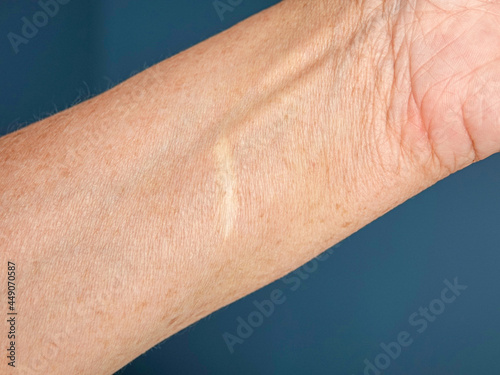An old scar from an accidental cut on the arm of a middle-aged woman.