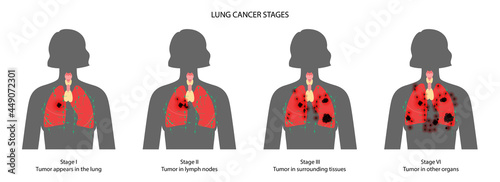 Lungs cancer stages