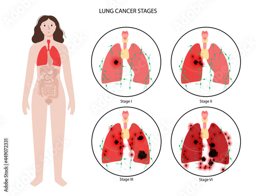 Lungs cancer stages