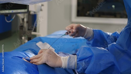 Vascular surgery. Radiologist performs endovascular operation with angiography machine. Doctor using contrast liquid for uterine fibroid embolization. Cardio-vascular examination. 4k video