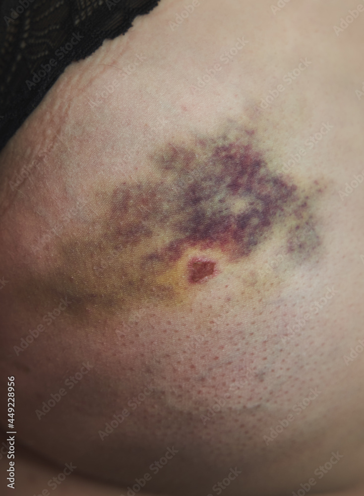 Fototapeta premium close up of skin with injury because of an accident