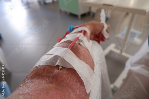 the arm of a patient with chronic kidney disease is connected to a hemodialysis machine