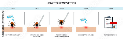 The correct way to remove a tick insect correctly. Prevention of infections transmitted by mite
