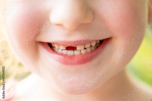 smile of a girl without an upper front tooth. toothless child. change of milk teeth