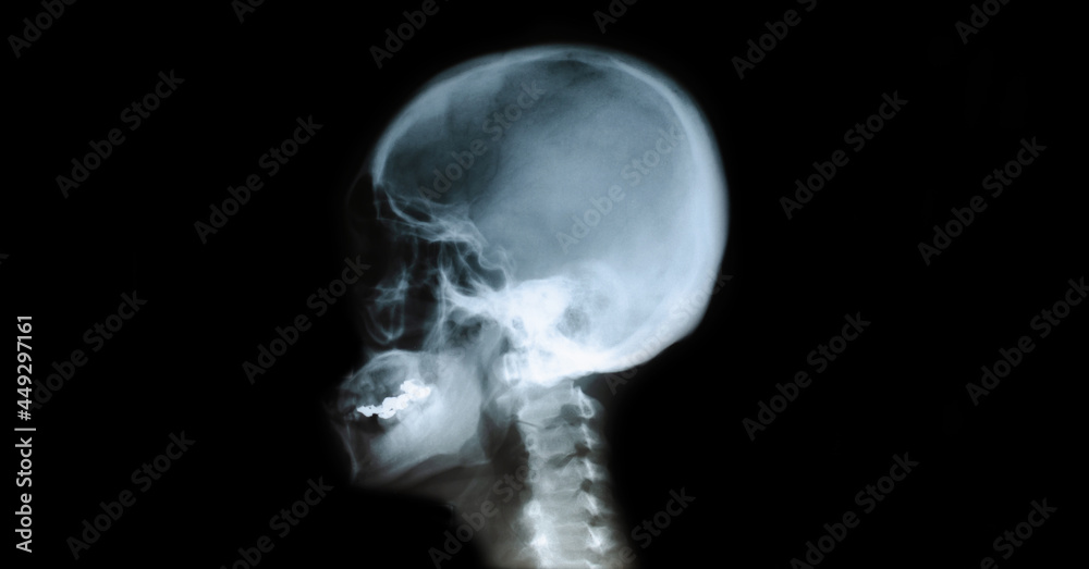 X-ray film of the head, child's skull. X-ray film of the head, child's skull.