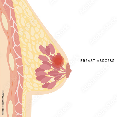 Medical Infographic Cross Section of Female Breast with Abscess. Information card with pus filled lump. Anatomy of Woman Chest with Infection. Inflammation of Mammary gland. Pain. Vector illustration.