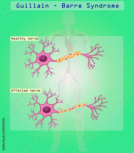 Covid 19 vaccine may have effect on Guillain-Barré syndrome (GBS). 